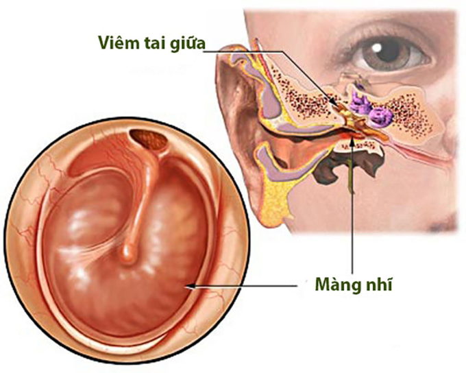 1-1749717695-6188-1749718355 Viêm tai giữa cấp mủ. Ảnh: Sở Y tế TP HCM