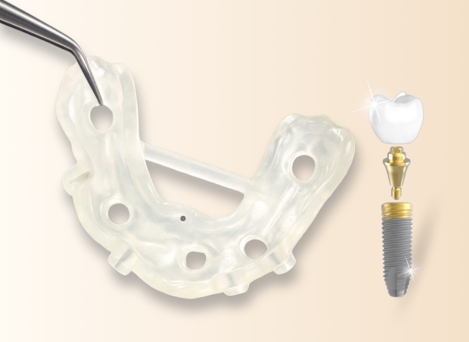 1-1750343824-3175-1750344776 Máng định vị hỗ trợ quá trình trồng răng Implant an toàn, chính xác. Ảnh: Nha khoa Kim
