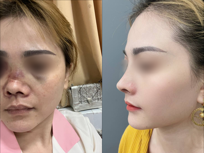 hinh-2-1750997399-9606-1751008468 Hình ảnh trước sau một ca sửa mũi phức tạp tại Nam An, từ cánh mũi bị cắt hỏng đến dáng mũi hài hòa, tự nhiên. Ảnh: Nam An