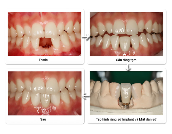 image-973195526-extractword-2-3068-6265-1749866386 Quá trình phục hình răng implant tại Thanh Hằng Beauty Medi. Ảnh: Thanh Hằng Beauty Medi
