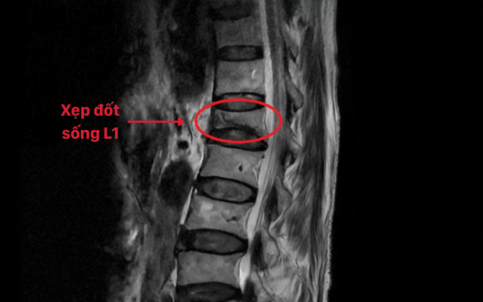 image-extractword-0-out-3019-1750664620 Kết quả chụp MRI phát hiện xẹp đốt sống L1. Ảnh: Bệnh viện Đa khoa Hồng Ngọc