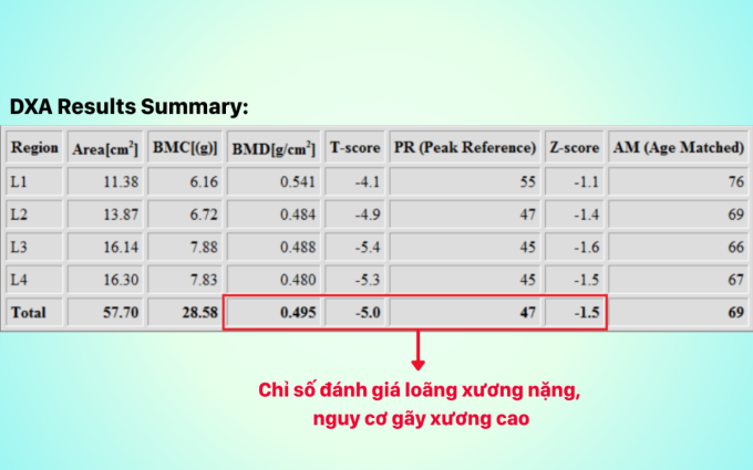 image-extractword-1-out-9028-1750664621 Kết quả đo loãng xương phát hiện loãng xương nặng. Ảnh: Bệnh viện Đa khoa Hồng Ngọc