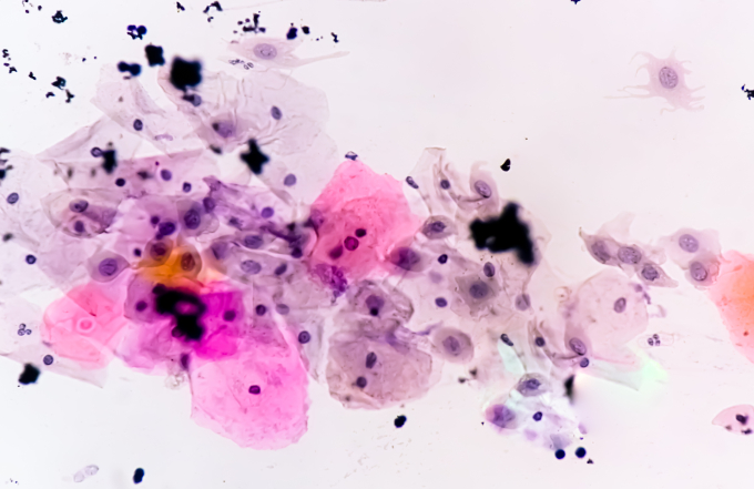 medium-vecteezy-paps-smear-ana-6444-3719-1750926570 Xét nghiệm PAP. Ảnh minh họa: Vecteezy