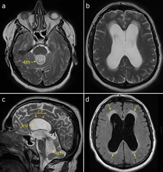oip-jpeg-1750067802-1750067817-3308-1750067902 Ảnh chụp MRI khoang dịch não tủy giãn to và mô não bị chèn ép chỉ còn mỏng ở thành sọ, dấu ấn điển hình của hydrocephalus. Ảnh: Lancet