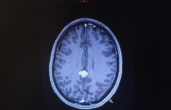 100626623-0-image-a-6-17534382-6334-2032-1753458327 Hình ảnh chụp khối u trong não. Ảnh: SWNS