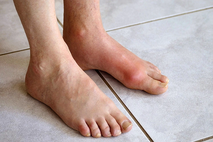 20200327benh-gout-1-1737085500684897849225 Chàng trai trẻ mắc bệnh gout ở tuổi 22, dấu hiệu cảnh báo từ đau khớp cổ chân - Ảnh 1.