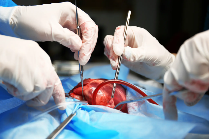 doctor-heart-operation-1083202-8323-5446-1752851837 Một ca phẫu thuật ghép tim. Ảnh: Adobe Stock