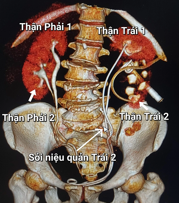 edit-5224975644193456110878062-1868-4640-1753343707 Hình ảnh trên phim chụp của người bệnh. Ảnh: Bác sĩ cung cấp