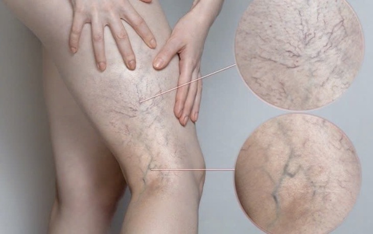 Chân đau nhức, mạch máu lộ rõ cảnh báo bệnh lý đang đe dọa 1/3 người trưởng thành - Ảnh 1.