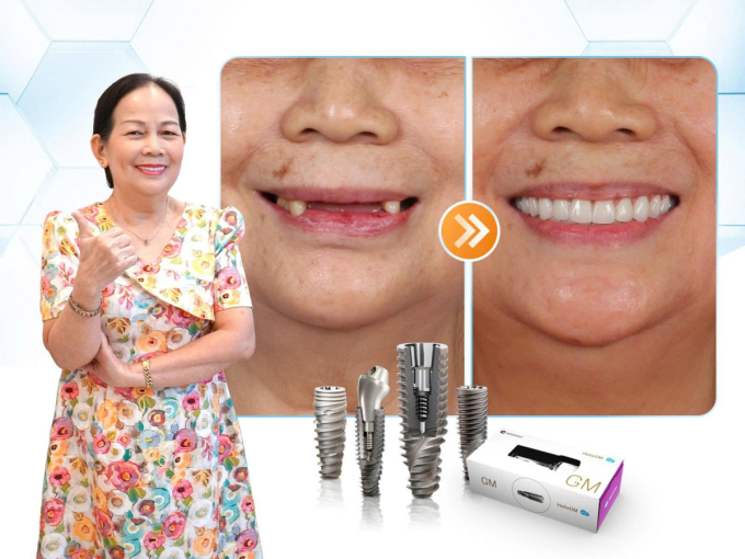 image-596904977-extractword-0-2557-5939-1751519251 Dr. Care Implant Clinic - nha khoa tiêu chuẩn châu Âu cho người trung niên