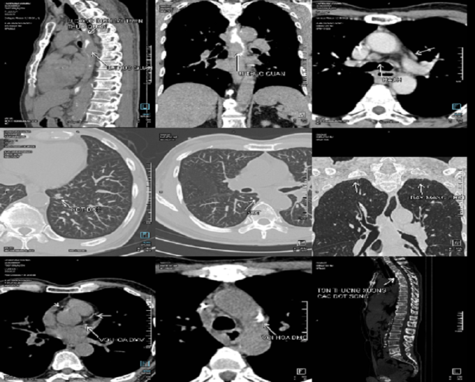 mri-1753842199-8687-1753842519 Phim chụp PET/CT của ông Hùng phát hiện ung thư thực quản lan rộng sang phổi. Ảnh: Bệnh viện Đa khoa Tâm Anh