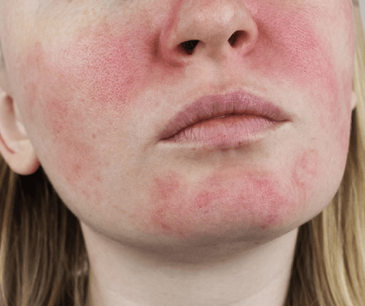 rosacea-17528228874111499247895 chăm sóc da - Ảnh 2.