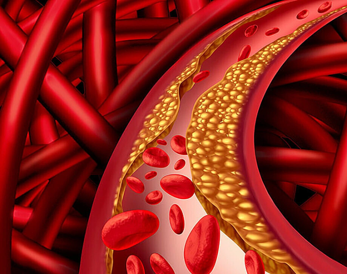 understanding-high-cholesterol-7042-1175-1751449555 Minh họa cholesterol tích tụ trong máu. Ảnh: My Health My Life