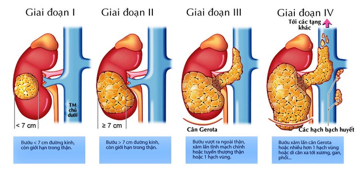 ung-thu-than-1753922387240747405669 Ung thư thận: Xu hướng gia tăng đáng báo động - Ảnh 1.