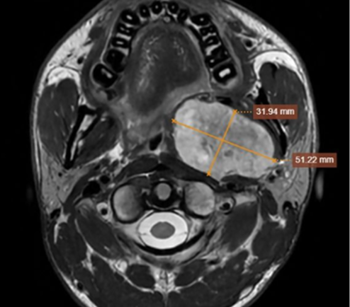 ungthu-1753757578-1753757598-1118-1753757780 Chụp MRI cho thấy khối u kích thước lớn vùng họng. Ảnh: Bệnh viện Đa khoa Tâm Anh