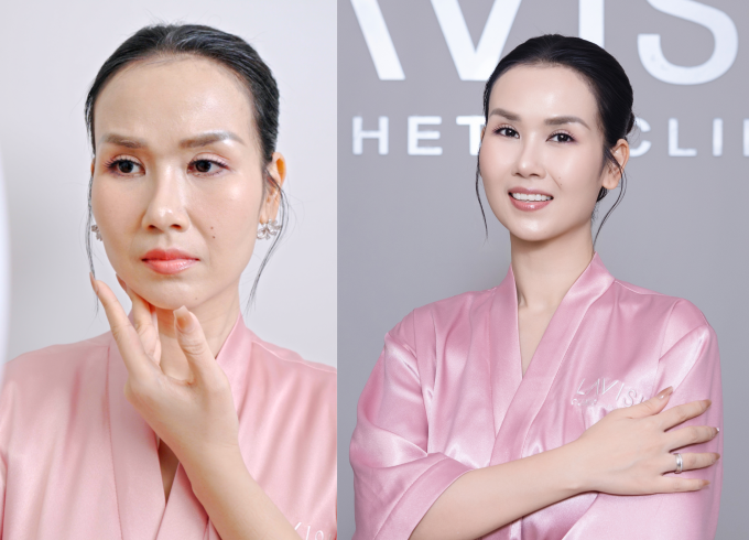 vht-b-a-1753427417-6332-1753427695 Võ Hạ Trâm trước và sau liệu trình trẻ hóa: đẩy lùi nếp nhăn, da săn, sáng hồng hơn trước. Ảnh: Lavish Clinic By Huyen Baby