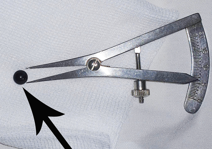 vie-n-da-n-bi-1753523922-17535-3934-4777-1753524167 Viên đạn bi sắt 6mm ở mí mắt được bác sĩ gắp ra ngoài. Ảnh: Bệnh viện cung cấp