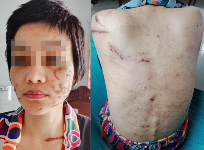 1-copy-1755177845-3725-1755178470 Nạn nhân Giao người chi chít vết thương sau khi bị chồng bạo hành như thời trung cổ. Ảnh: Gia đình cung cấp