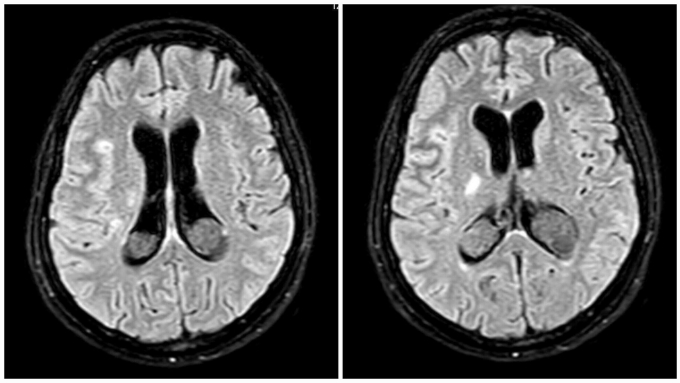 2-1754019080-1754019168-1862-1754019175 Kết quả MRI sọ sảnphụcho thấy tổn thương chất trắng rải rác hai bên bán cầu não. Ảnh: Bác sĩ cung cấp
