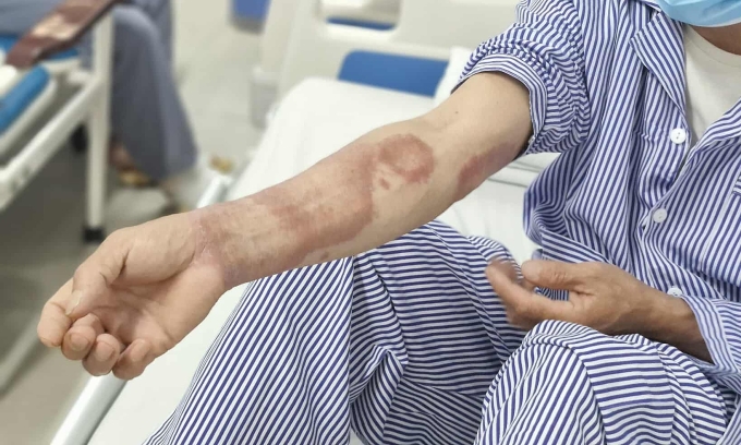 523867869-714865818116222-7265-7990-5899-1753955702 Tổn thương da ở bệnh nhân phong. Ảnh: Lê Nga