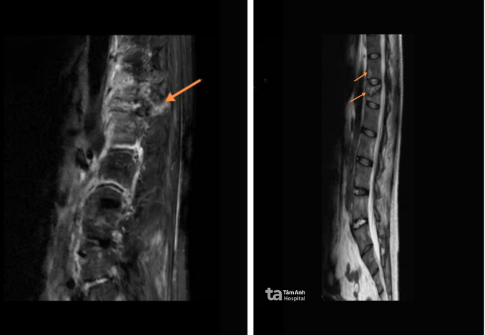 nganvong1-1754005370-3722-1754005500 Chụp MRI cho thấy đốt sống ngực T12 của anh Thanh bị gãy xẹp. Ảnh: Bệnh viện Đa khoa Tâm Anh
