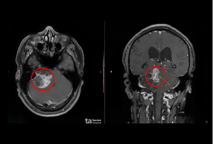 tk1-1755302357-3022-1755302518 Chụp MRI 1.5 Tesla cho thấy khối u chèn ép thân não anh Khôi. Ảnh: Bệnh viện Đa khoa Tâm Anh
