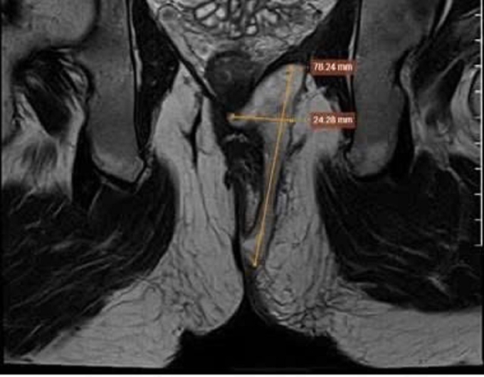 z6898451760792-cb818a70ac05f23-7750-8211-1755224544 Hình chụp MRI cho thấy đường rò (mũi tên vàng) ăn luồng phức tạp. Ảnh: Bệnh viện Đa khoa Tâm Anh